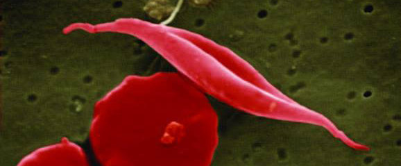 Bild på röda blodkroppar från patient med sickelcellanemi.