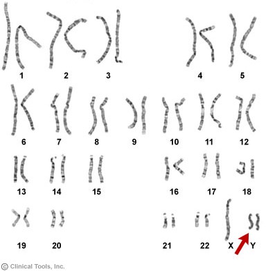 Bild på alla kromosomer hos en person med XYY-syndromet.  